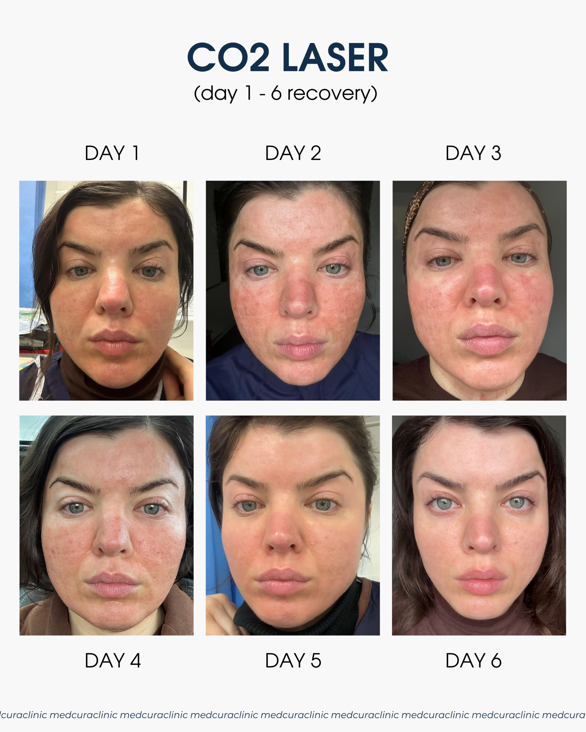 co2 laser day by day
