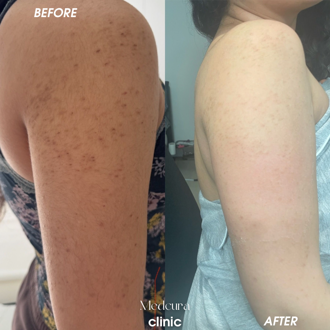 keratosis pilarious treatment (1)