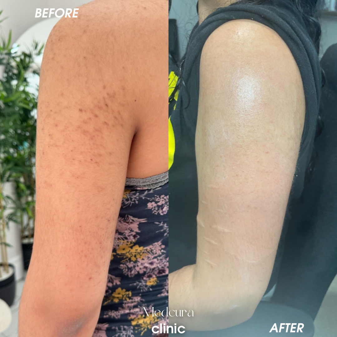 keratosis pilarious treatment 12421
