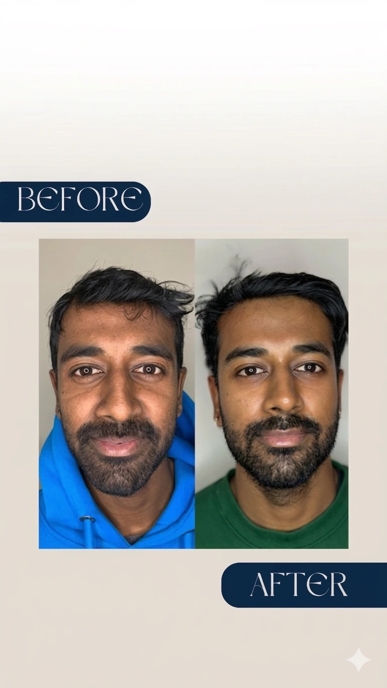 microneedling with exosomes (4 sessions )-compressed