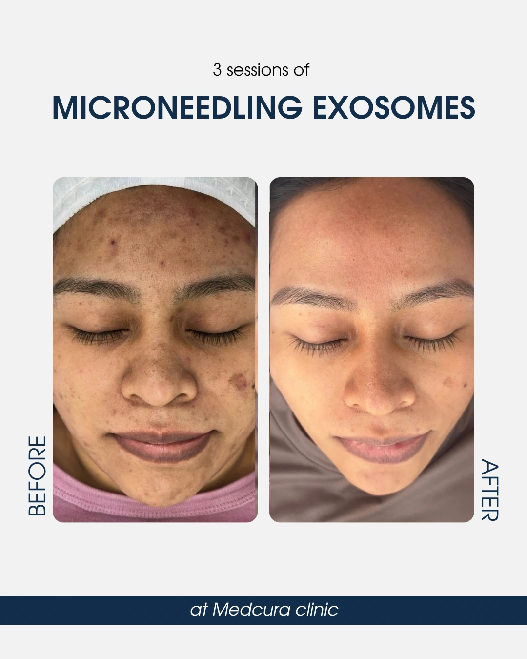 microneedling with exosomes -compressed