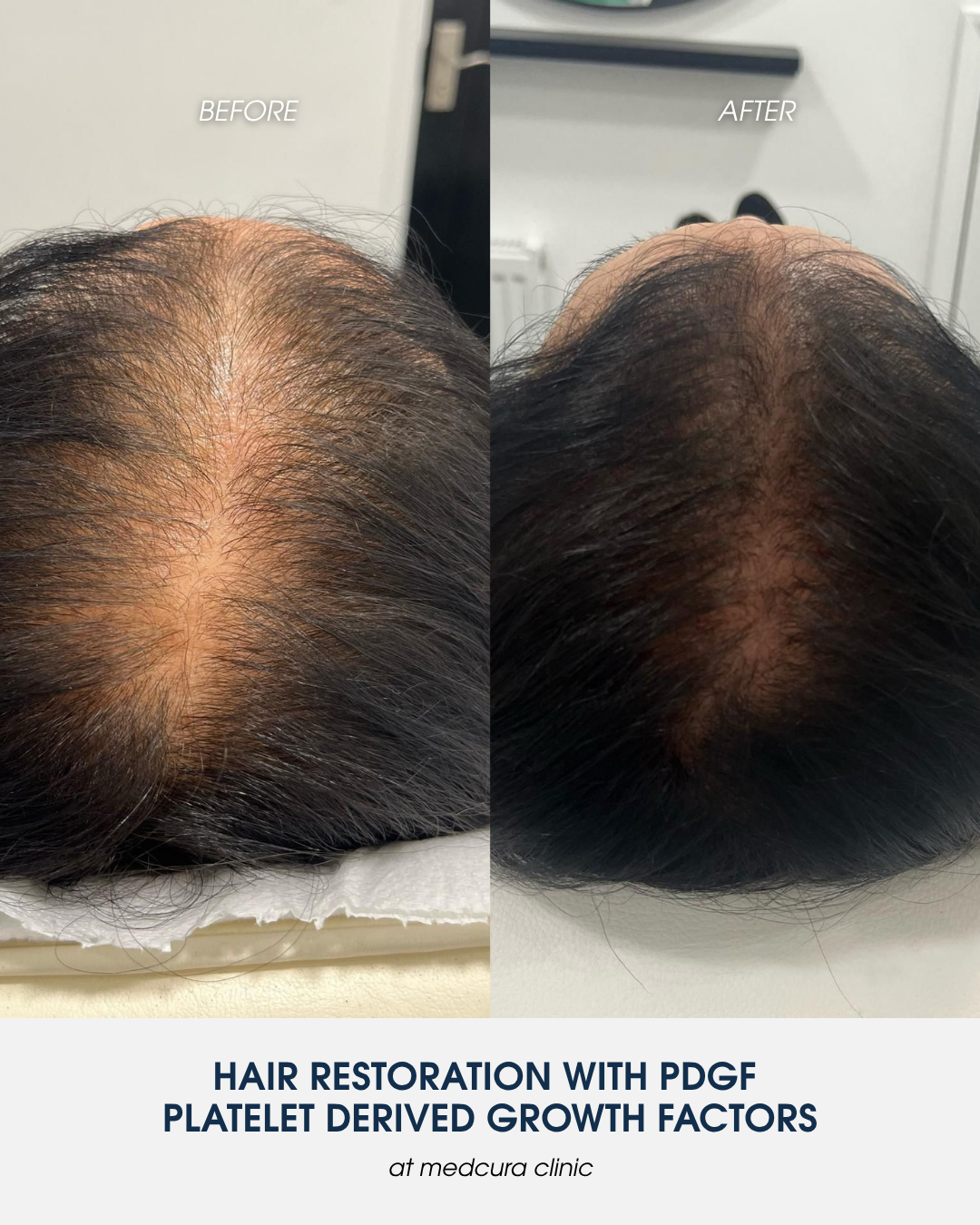 pdgf autologous exosomes-Hair Loss Treatments