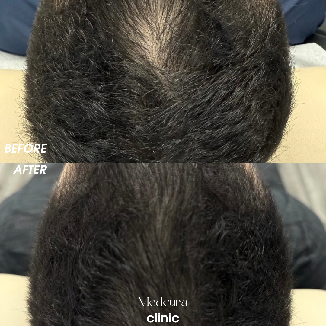 prp treatment 1234
