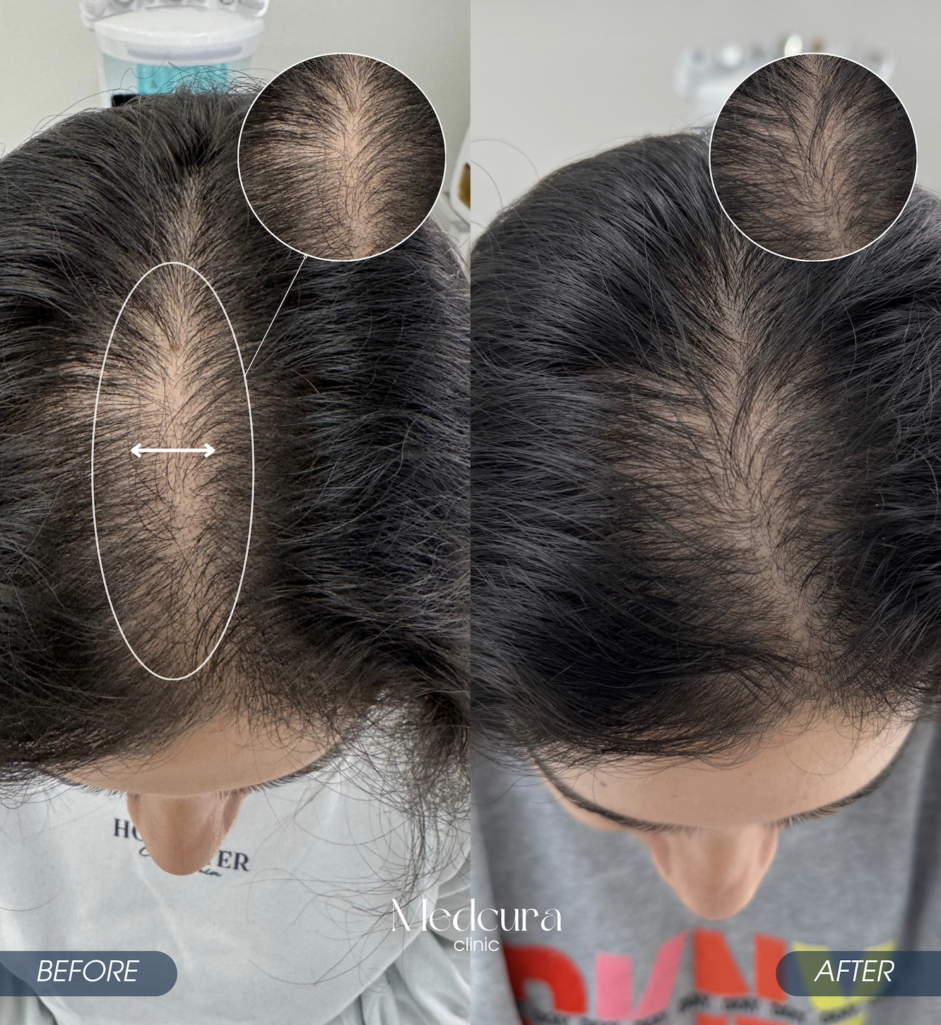prp with exosomes for hair