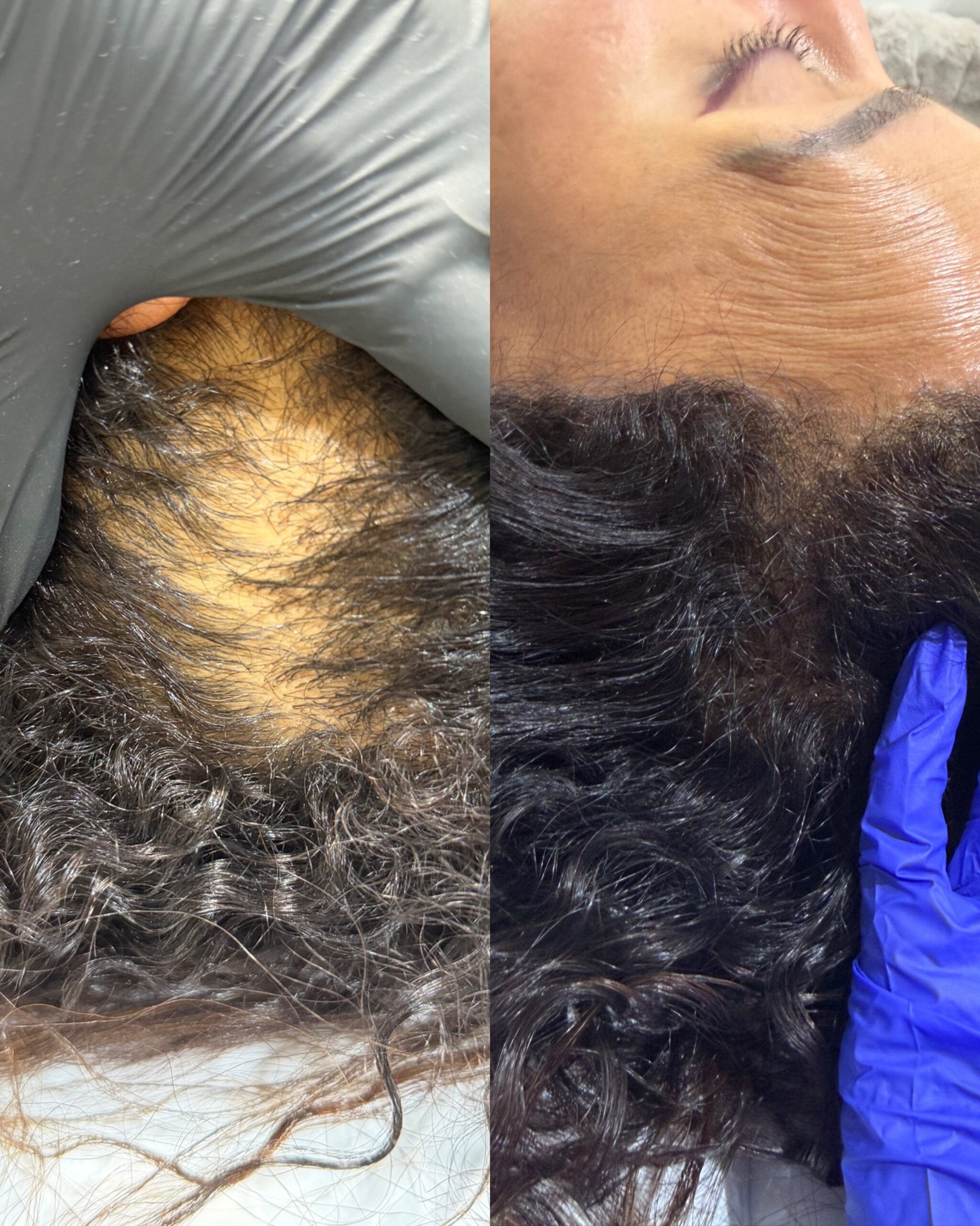 Hair Loss Treatments Medcura stanmore client result