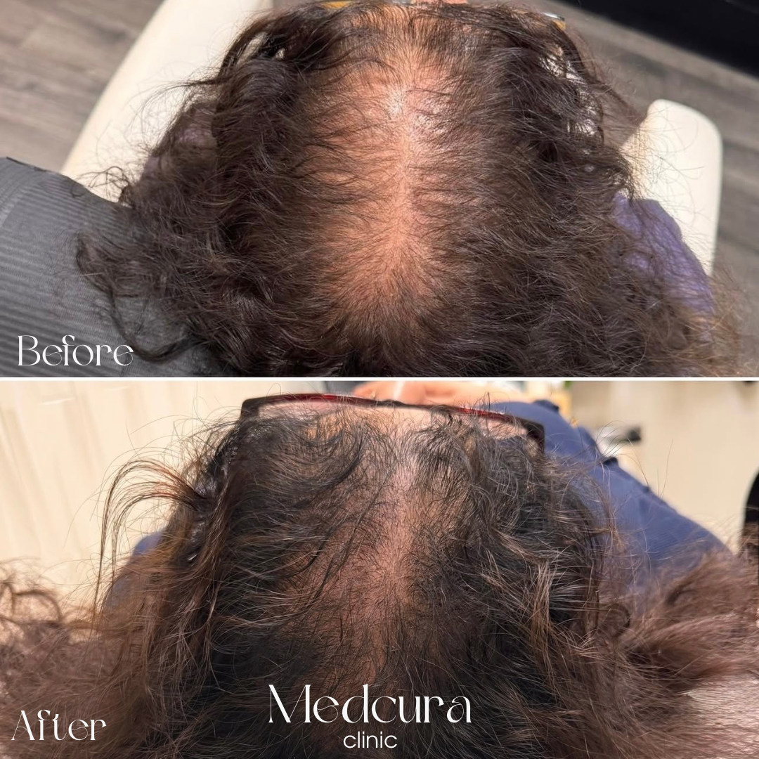 Hair Loss Treatments Medcura stanmore client results before and after