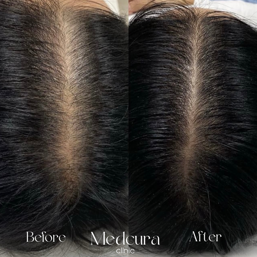Hair Loss Treatments Medcura stanmore female client