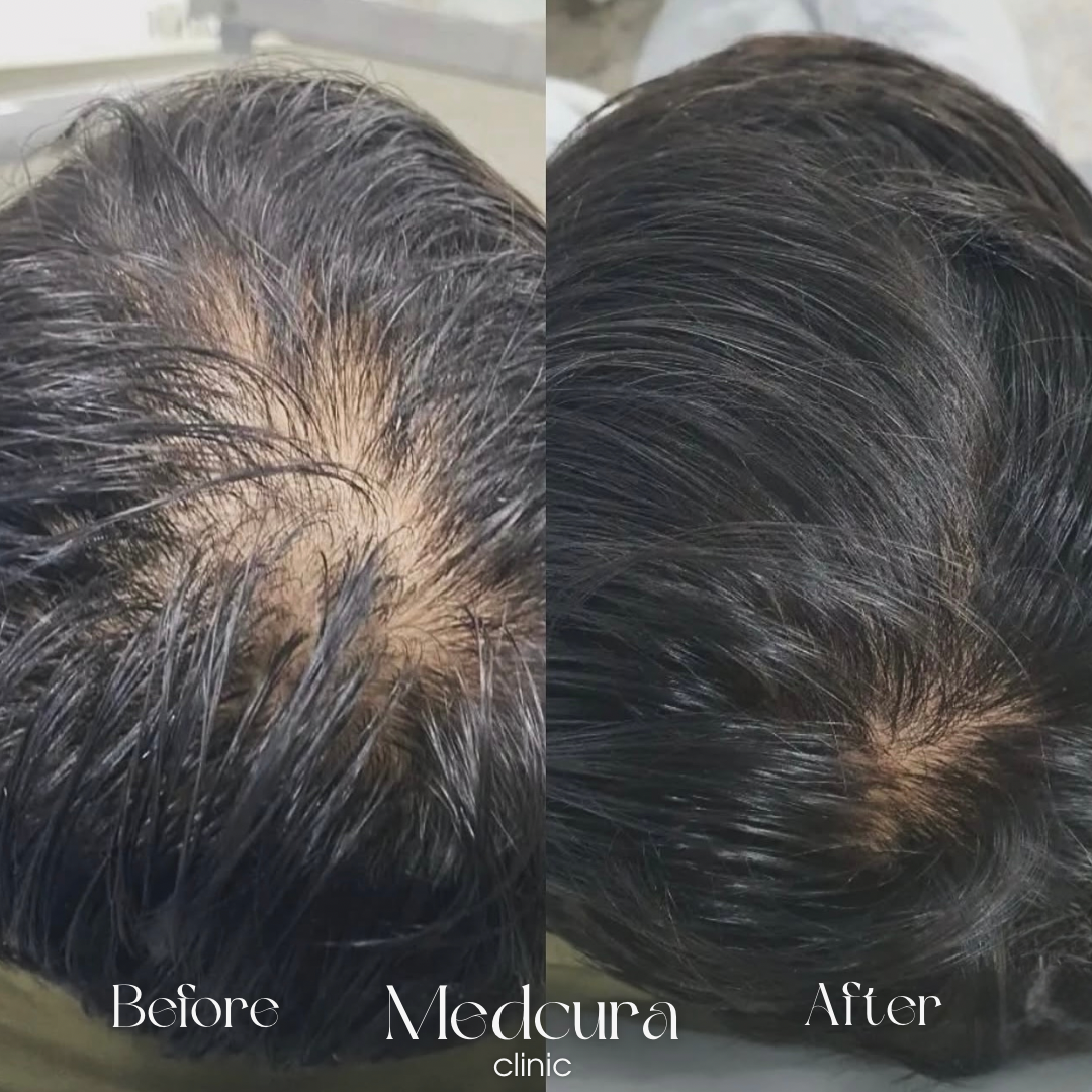 Hair Loss Treatments Medcura stanmore male client results