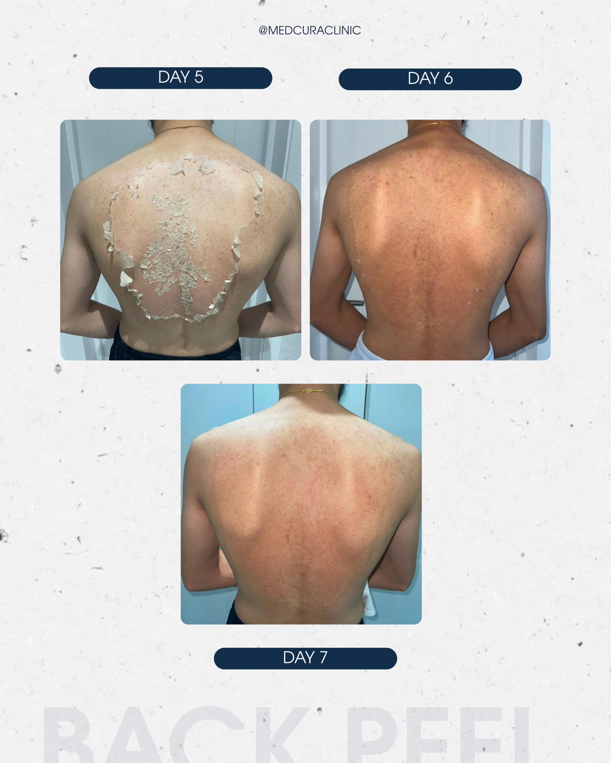 back-peel-treatment-medcura-skin-clinic-uk-stanmore-harrow