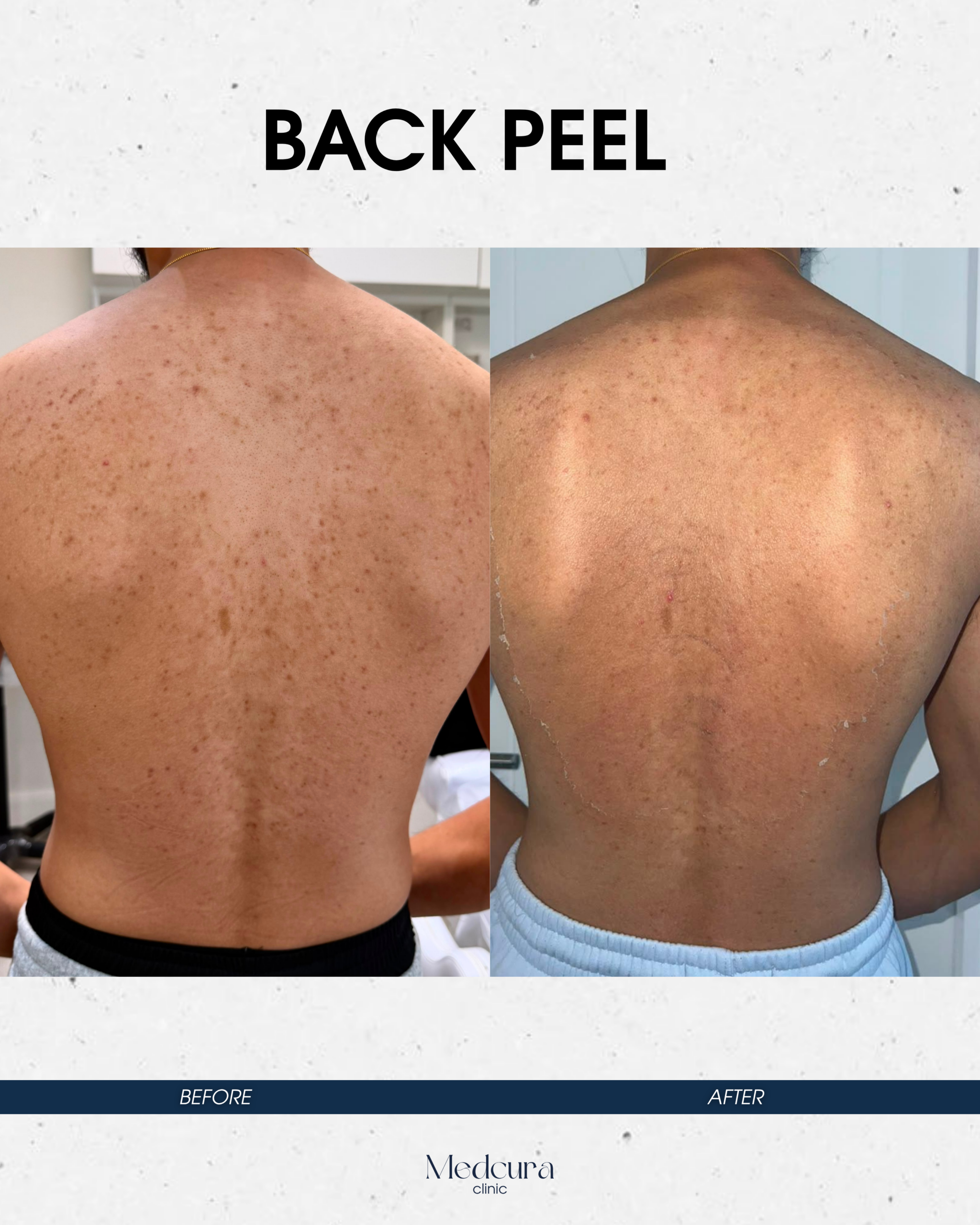 back-peel-treatment-medcura-skin-clinic-uk-stanmore-male