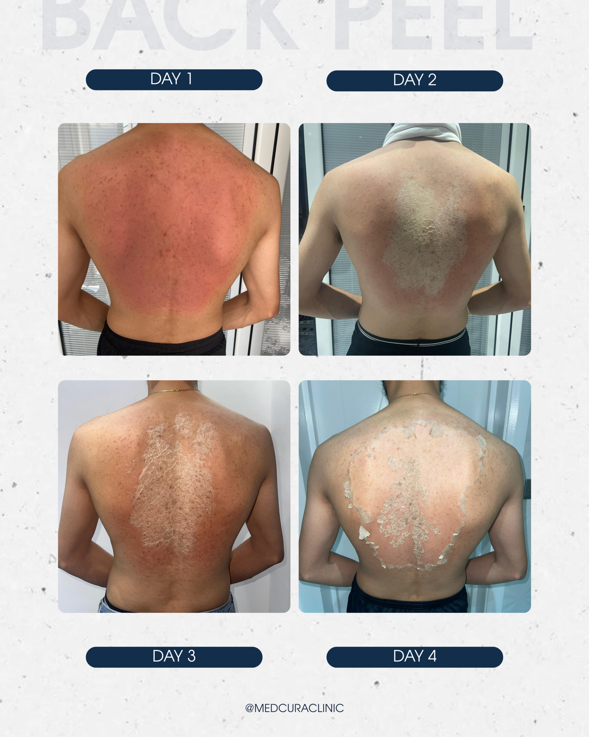 back-peel-treatment-medcura-skin-clinic-uk-stanmore