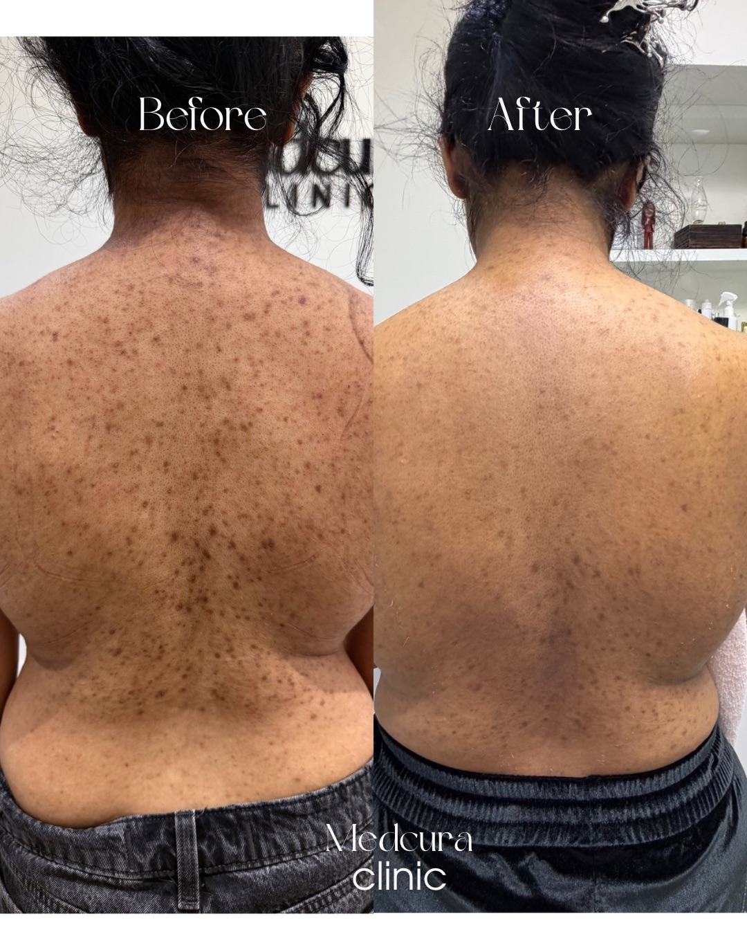 body-back-peel-treatment-medcura-skin-clinic-uk-stanmore-before-and-after