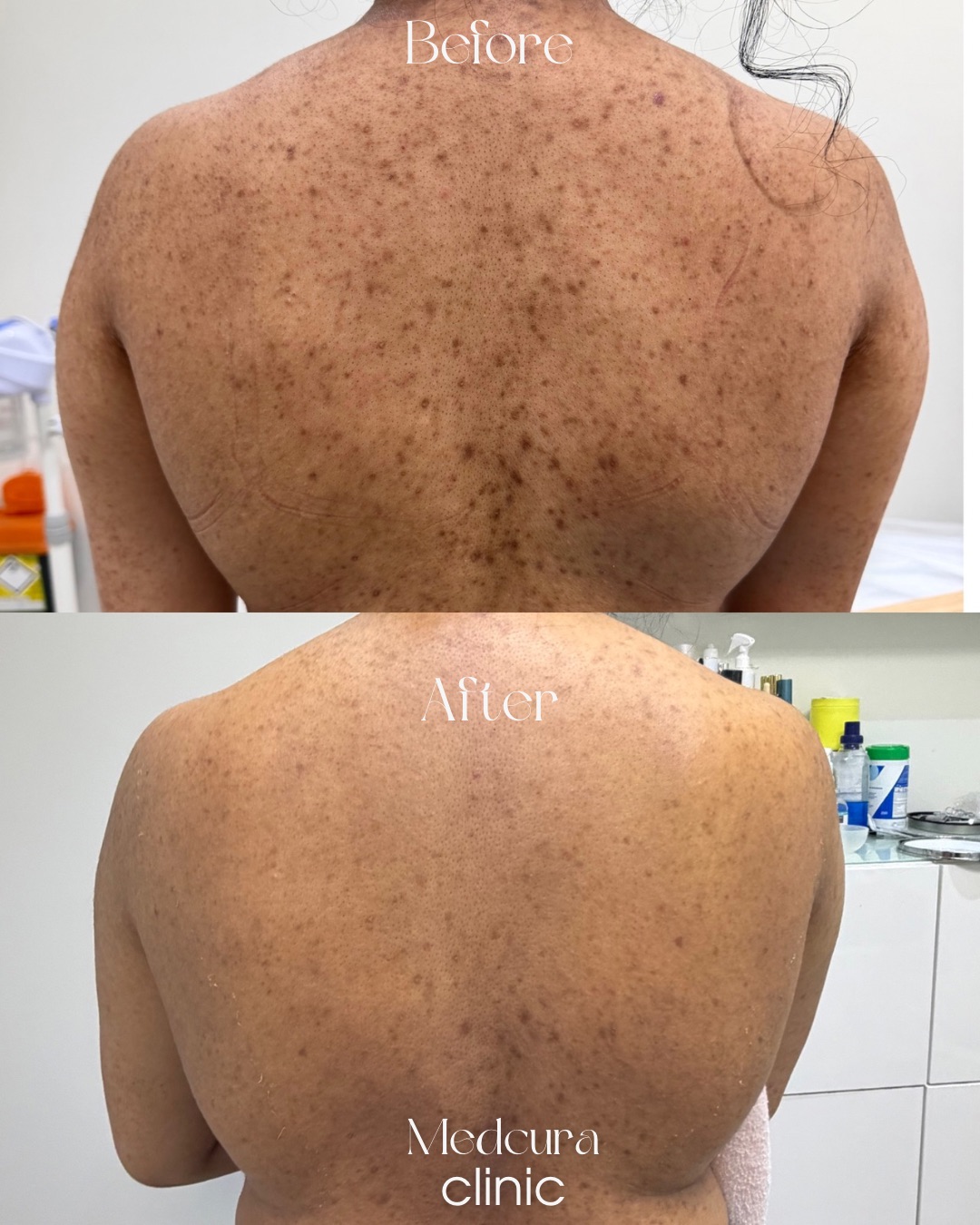 body-back-peel-treatment-medcura-skin-clinic-uk-stanmore-female