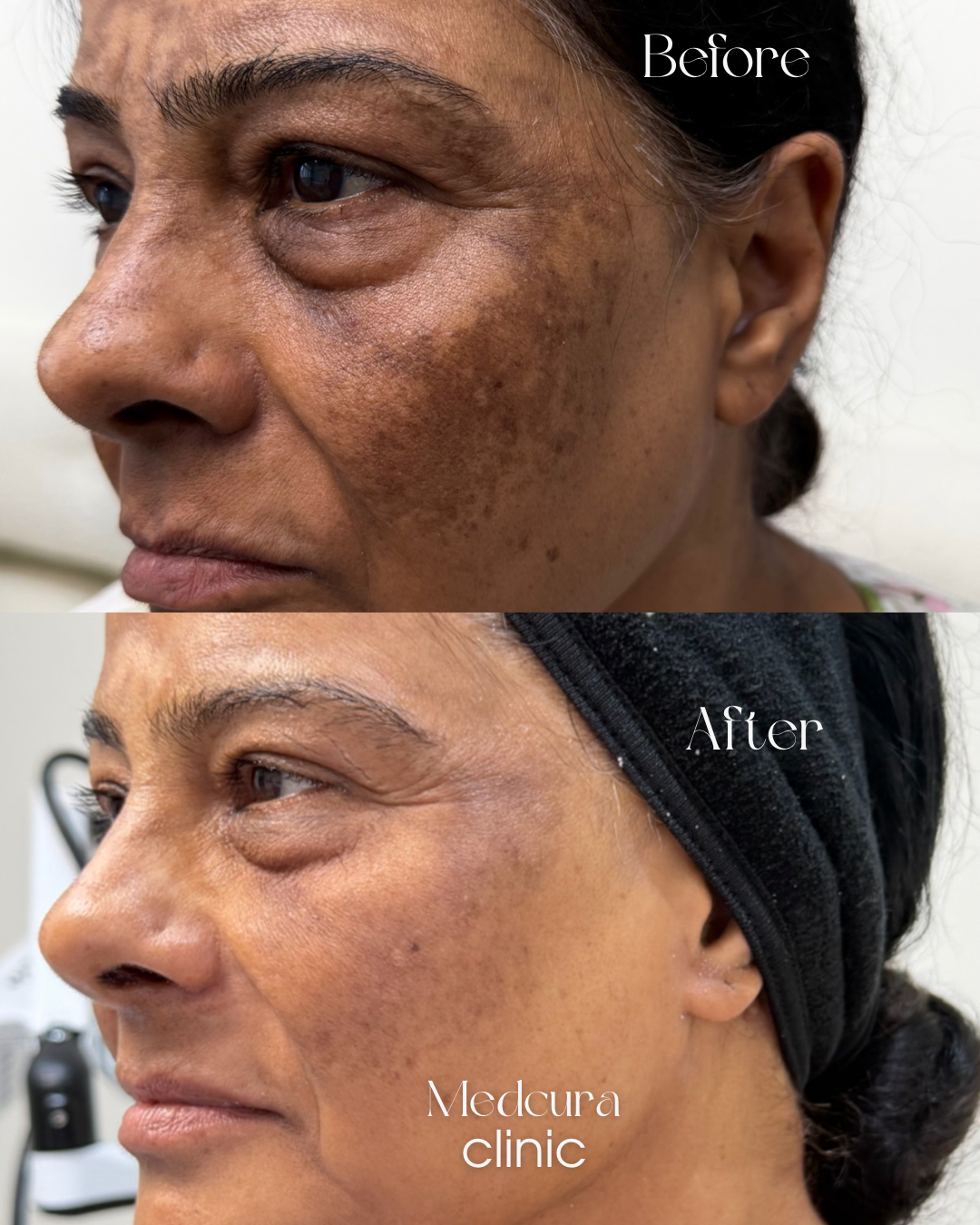 melasma-treatment-medcura-uk-stanmore-before-and-after5